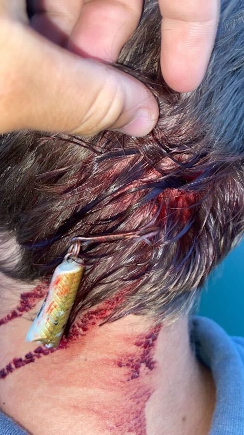 The back section of a Storm Kickin’ Stick, embedded deeply into the back of Elliott’s head. He had to visit the emergency room to have the hook removed.